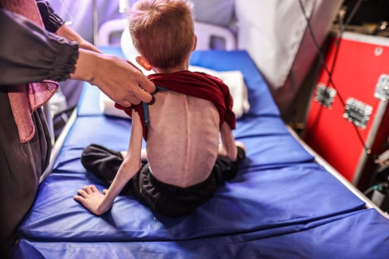 anak malnutrisi di gaza