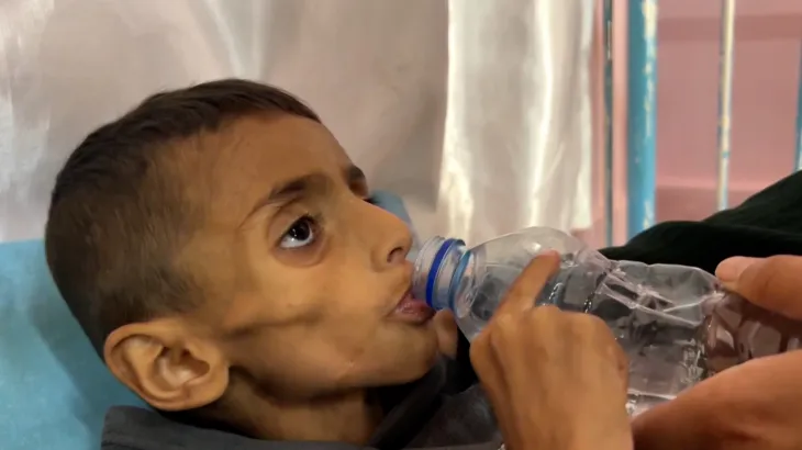 anak malnutrisi gaza